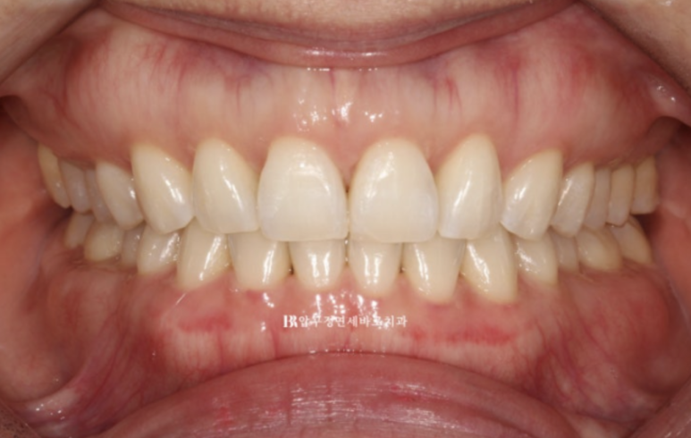 인비절라인 라이트 가위교합 치아 벌어짐 치료 관련 이미지 8
