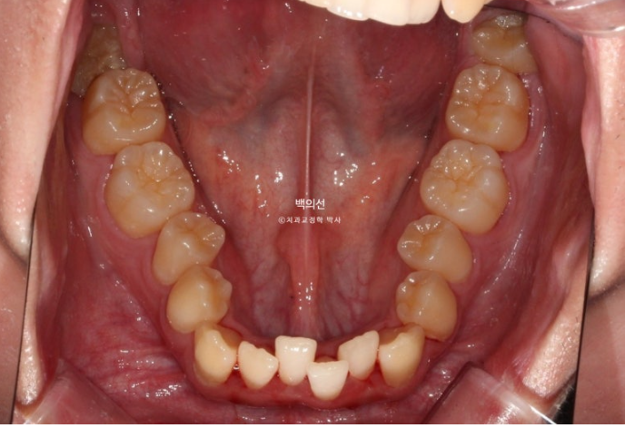 유학생 교정 인비절라인 라이트 치료기간 5개월 관련 이미지 5