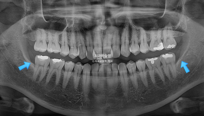 30대 MSE 악궁확장 덧니 반대교합 비발치 클리피씨 부작용 관련 이미지 6