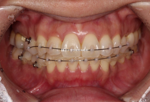 Short-Term Orthodontic Treatment Period for an Overseas Korean in Their 40s with Anterior Crossbite and Buck Teeth image 5