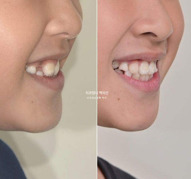 어린이 교정 인비절라인 퍼스트 비대칭 반대교합 어린이 성장 교정 관련 이미지 23