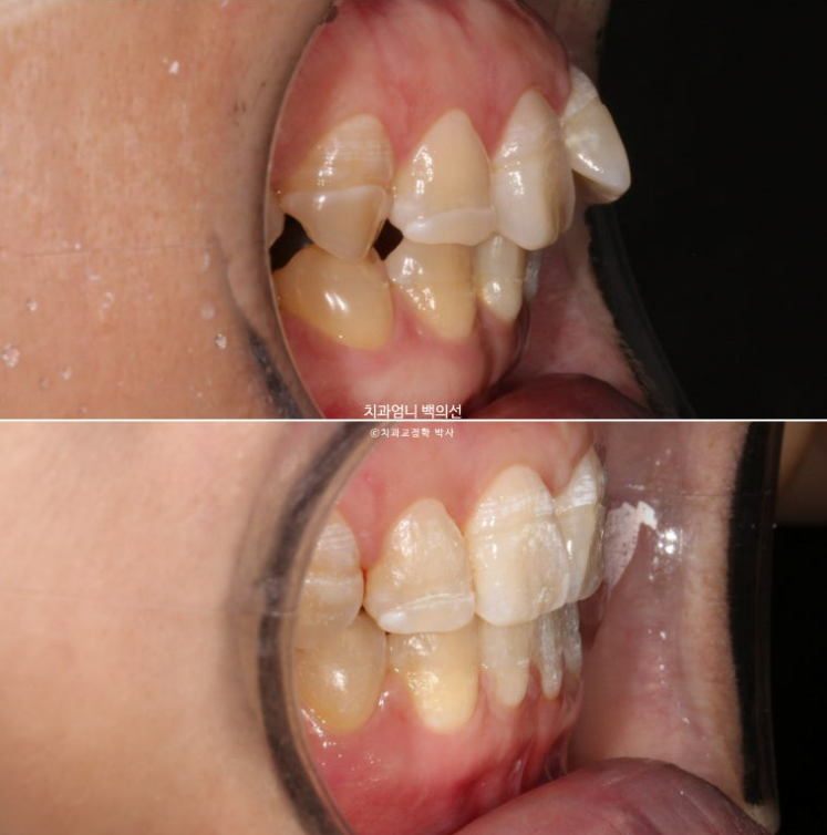 30대 교정 돌출입 교정 덧니 발치교정 치료기간 1년 8개월 관련 이미지 15