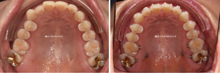 50대 인비절라인 개방교합 합입교정 미니스크류 관련 이미지 5