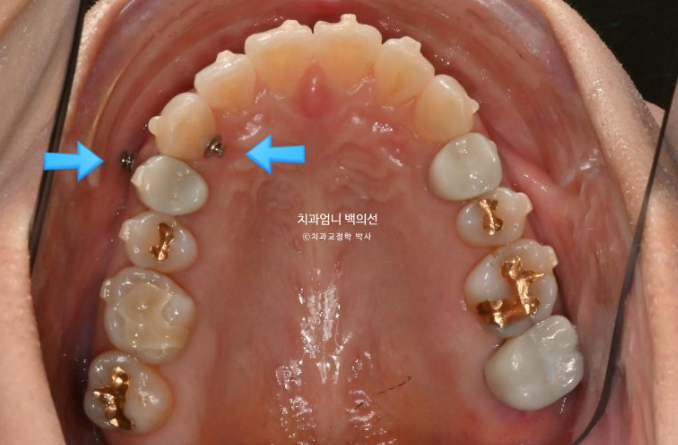 50대 캔팅 교합평면 기울어짐 덧니 교정 인비절라인 라이트 교정? 관련 이미지 6