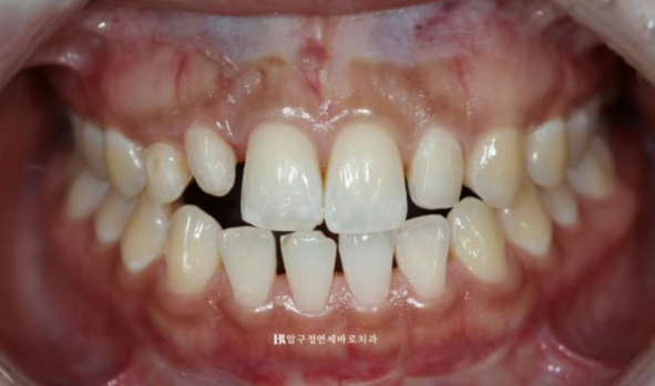 왜소치 치료 잔존유치 무삭제 라미네이트 후기 관련 이미지 4