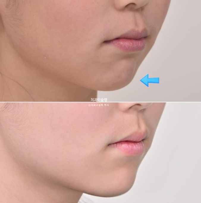 돌출입 비발치 어린이 교정 입술부전증 호두주름 호두턱 토끼이빨 인비절라인퍼스트 관련 이미지 22