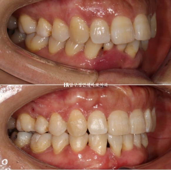 40대 치아교정 가능할까요? 치주염 있어도 치아교정 가능할까요? 임플란트 없이 교정하기 관련 이미지 11
