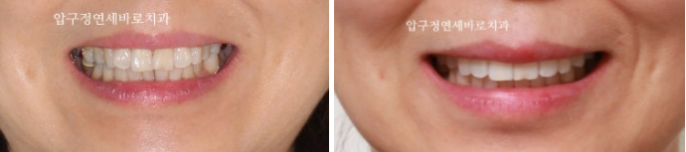 40대 후반 치아교정 해도 될까요? 관련 이미지 6