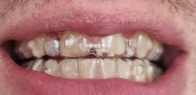 앞니 선천적 결손 인비절라인 임플란트 과개교합 치료 기간 관련 이미지 7