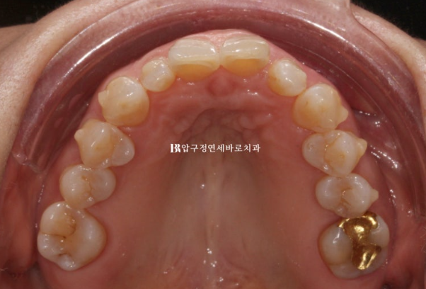 50대 인비절라인 라이트 교정 사례|왜소치·과개교합 개선 후 무삭제 라미네이트까지 관련 이미지 7