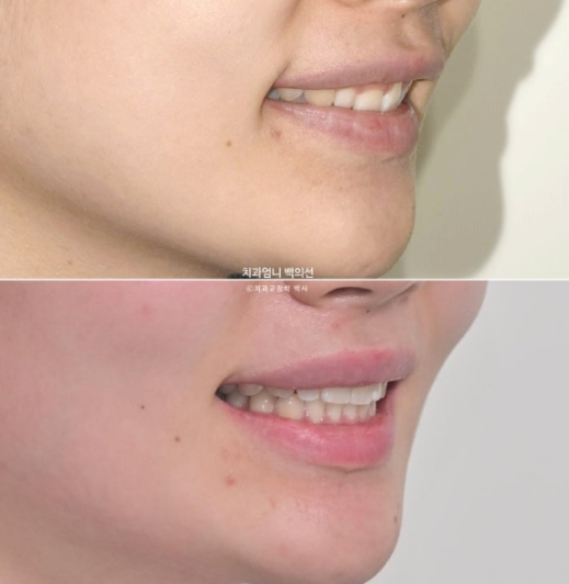 Inward-Tilted Teeth Orthodontic Treatment Review | Actual Case Improved with Non-Extraction Orthodontic Treatment for Gummy Smile, Deep Overbite & Gum Asymmetry — Gangnam Orthodontic Clinic image 19