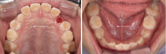Simultaneous Arch Expansion and Teeth Alignment for Elementary School Children with Invisalign｜Invisalign First image 4