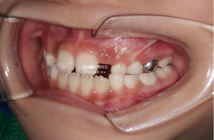 어린이 교정 인비절라인 퍼스트 비대칭 반대교합 어린이 성장 교정 관련 이미지 5