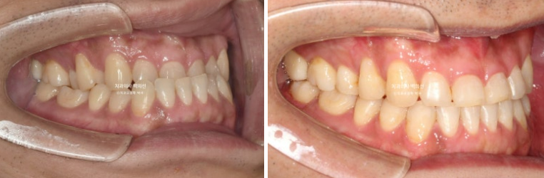 30대 주걱턱 비수술 비발치 교정 후기 관련 이미지 9