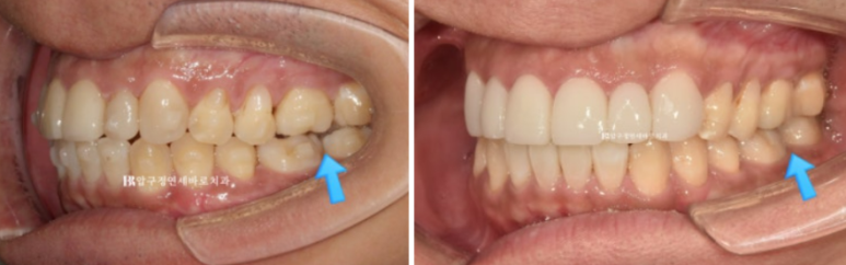 40대 치아교정 인비절라인 라이트 덧니 교정 어금니 교합 부작용 관련 이미지 11