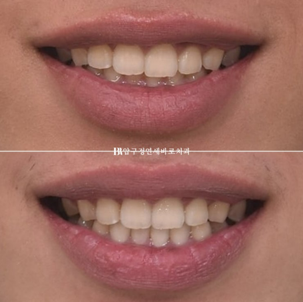 Can Invisalign Lite Correct Deep Bite and the Occlusal Plane? | A Real Case With 14 Aligners Over 4 Months image 11