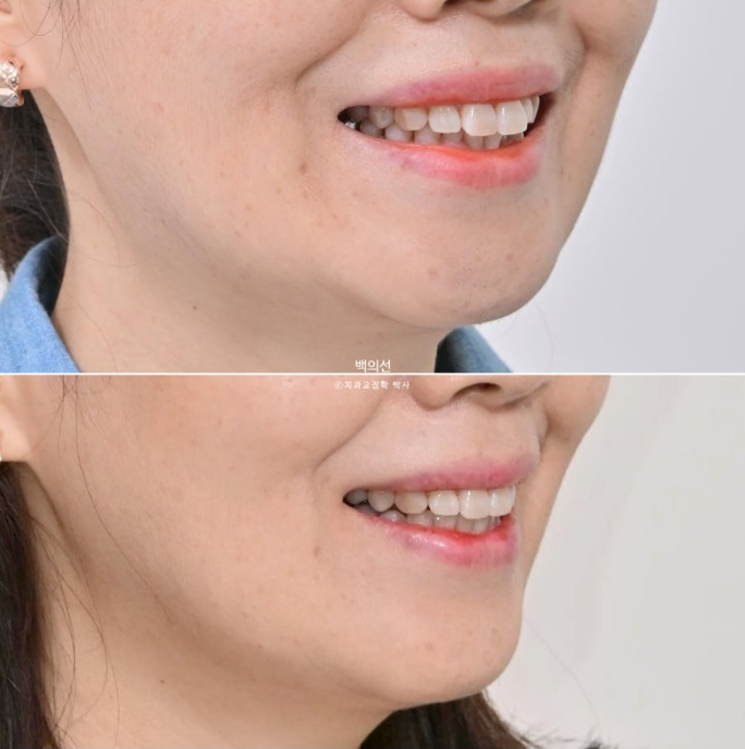 40대 인비절라인 라이트 앞니 돌출 과개교합 덧니 교정 후기 관련 이미지 20