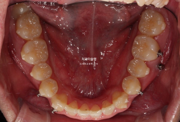 비대칭 비발치 거미스마일 잇몸미소 중심선 가위교합치료 무삭제 라미네이트 관련 이미지 17