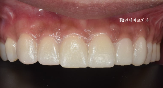 무삭제 라미네이트 젤라미 정말 최소삭제도 안할까? 관련 이미지 2
