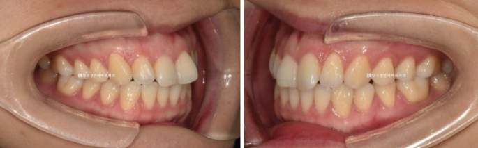 Can Rabbit Teeth Be Corrected? 5-Month Real Case of Butterfly Teeth Anterior Partial Orthodontic Treatment image 4