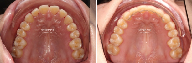앞니 벌어짐 합죽이 방지 교정 기간 1년 4개월 관련 이미지 11
