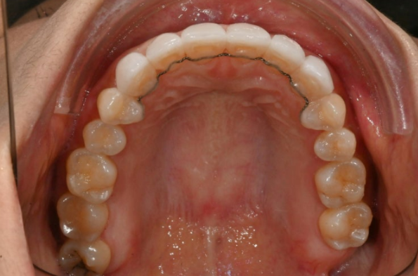 Can Gaps Between the Front Teeth Be Treated with No-Prep Veneers Alone? A Real Case Completed with Gelami After Invisalign Lite image 21