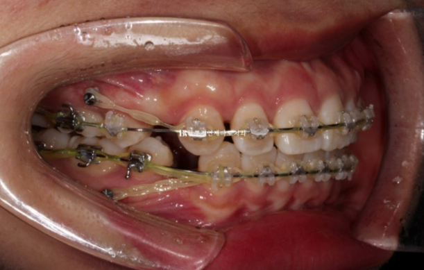 돌출입 교정 입동굴 클리피씨 교정 후기 관련 이미지 6