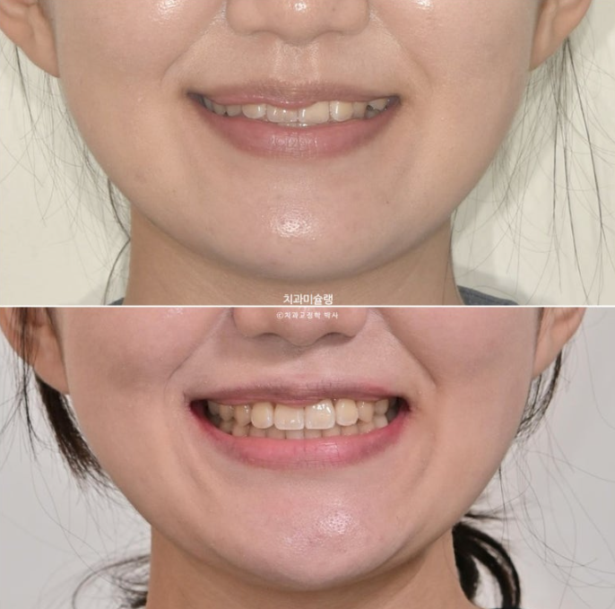 비발치 비수술 주걱턱 반대교합 재교정 치료 관련 이미지 16