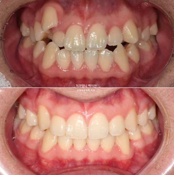 투명교정 인비절라인 덧니 교정 치료기간 알아보기 관련 이미지 1