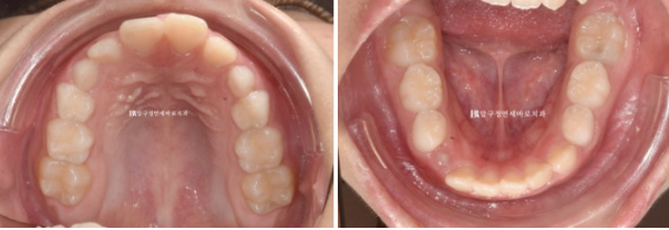 강남 소아교정 인비절라인 퍼스트 어린이 반대교합 관련 이미지 5