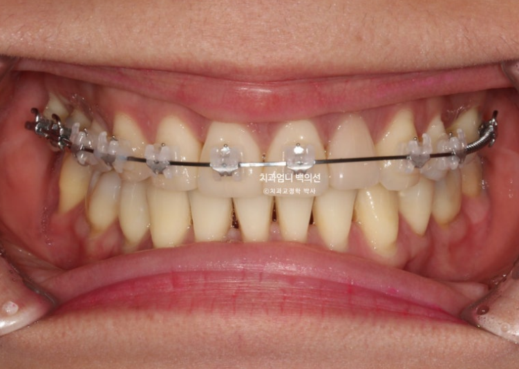 옥니 교정 역교정 재교정 무턱교정 치료기간 1년 10개월 관련 이미지 8