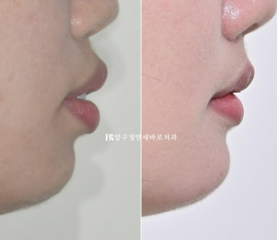 돌출입 교정 입동굴 클리피씨 교정 후기 관련 이미지 17