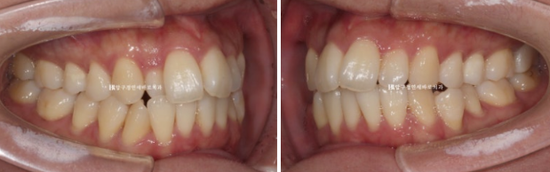 예비신부 교정 단기 앞니 부분교정 치료기간 6개월 관련 이미지 4