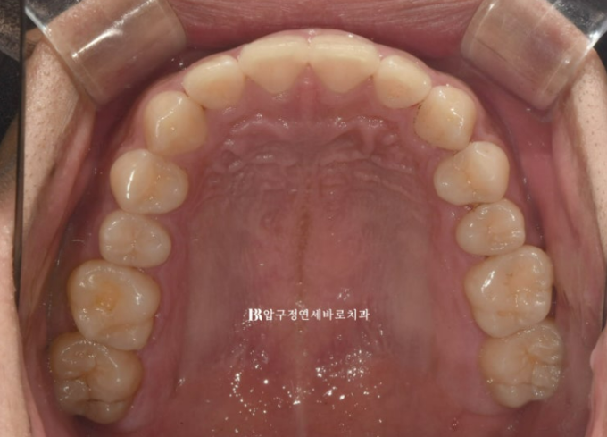 Can Invisalign Lite Correct Deep Bite and the Occlusal Plane? | A Real Case With 14 Aligners Over 4 Months image 3