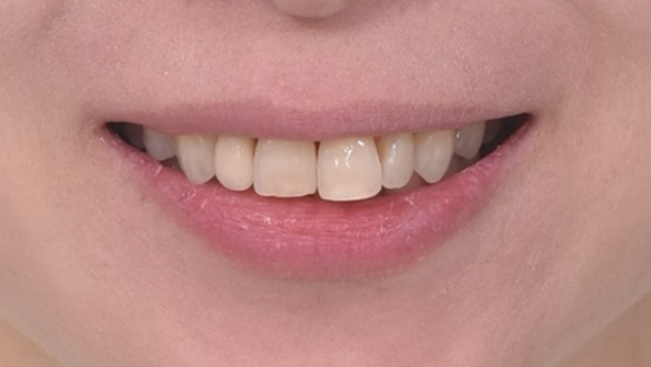 Can Invisalign Lite Work for Patients in Their 40s? A Real Case Improving Scissor Bite and Deep Bite in 10 Months image 2