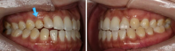 왜소치 치료 잔존유치 무삭제 라미네이트 후기 관련 이미지 2