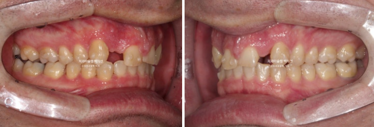 앞니 선천적 결손 인비절라인 임플란트 과개교합 치료 기간 관련 이미지 9