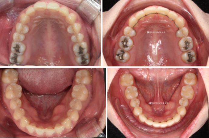 인비절라인 돌출입 발치교정 거미스마일 잇몸미소 교정 관련 이미지 11