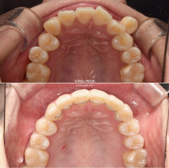 비발치 교정 덧니 인비절라인 교정 절단교합 반대교합 치료기간 1년 6개월 관련 이미지 24