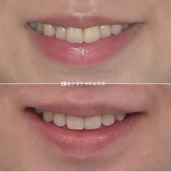 Invisalign Success Depends on Wearing Them Consistently|9-Month Real Treatment Case of Crowding & Underbite image 13