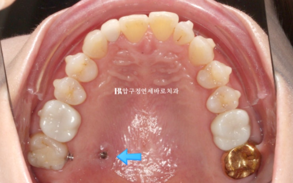 40대 인비절라인 라이트|가위교합도 10개월 만에 개선 가능할까요? 발치 없이 치료한 실제 증례 관련 이미지 8