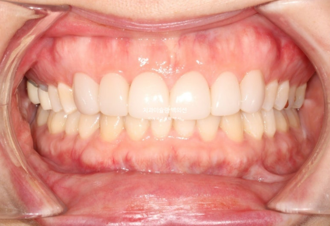 비발치 덧니 교정 인비절라인 과개교합 교정 무삭제 라미네이트 치료 후기 관련 이미지 16