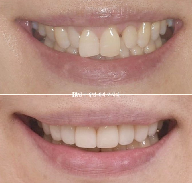 Can It Be Done in Your 50s? Real Results from Limited Front Teeth Orthodontics + No-Prep Laminate Veneers Revealed image 1