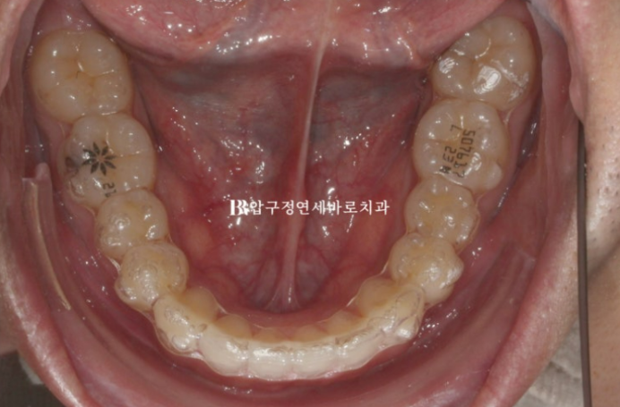 Can Invisalign Fix a Gap Between the Front Teeth? ๐ฎ A Real 9-Month Case Finished Without Remaking Aligners image 3