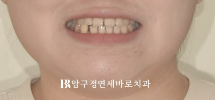 앞니 벌어짐 교정, 인비절라인이 더 잘 될까? 치아벌어짐 7개월 실제 사례 관련 이미지 6
