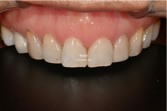 40대 무삭제 라미네이트 블랙트라이앵글 레진 치료 관련 이미지 3
