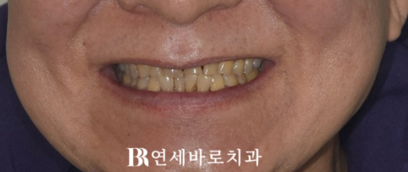 60대 무삭제 라미네이트 앞니 부분교정 치료 관련 이미지 2