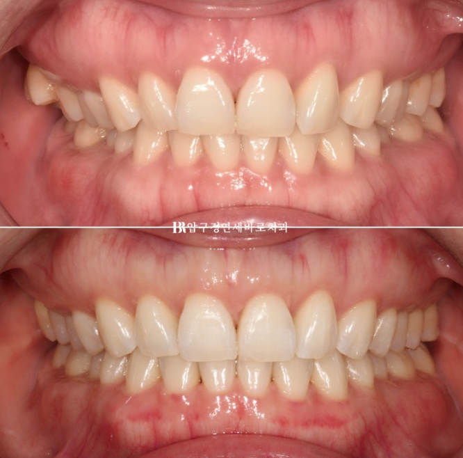 인비절라인 라이트 가위교합 치아 벌어짐 치료 관련 이미지 1