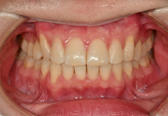인비절라인 라이트 돌출 과개교합 중심선 교정 치간삭제 치료기간 관련 이미지 9