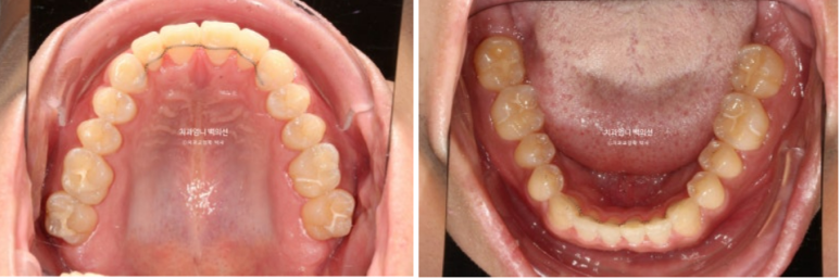 앞니 부분교정 덧니 교정 블랙트라이앵글 부정교합 마모 시뮬레이션 치료기간 5개월 관련 이미지 13